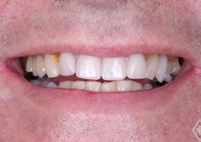 DENTURE AND WHITENING - AFTER