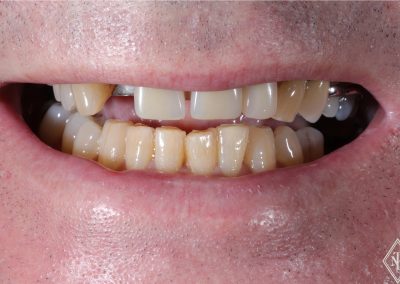 DENTURE AND WHITENING - BEFORE